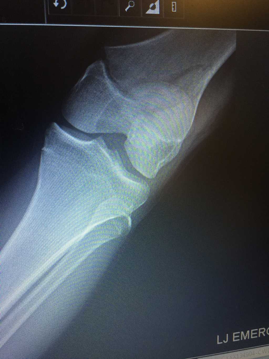 x-ray